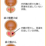 前立腺肥大症とは