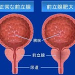 前立腺肥大症高温度治療