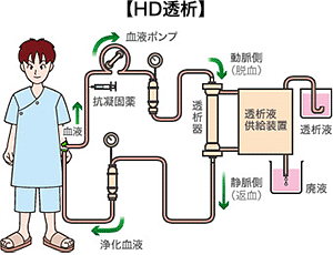 HD透析