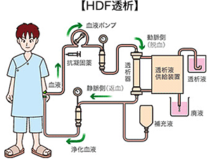 HDF透析