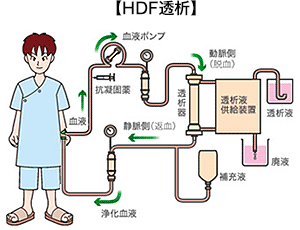 血液透析の方法 医新会